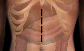 Upper Midline Incision